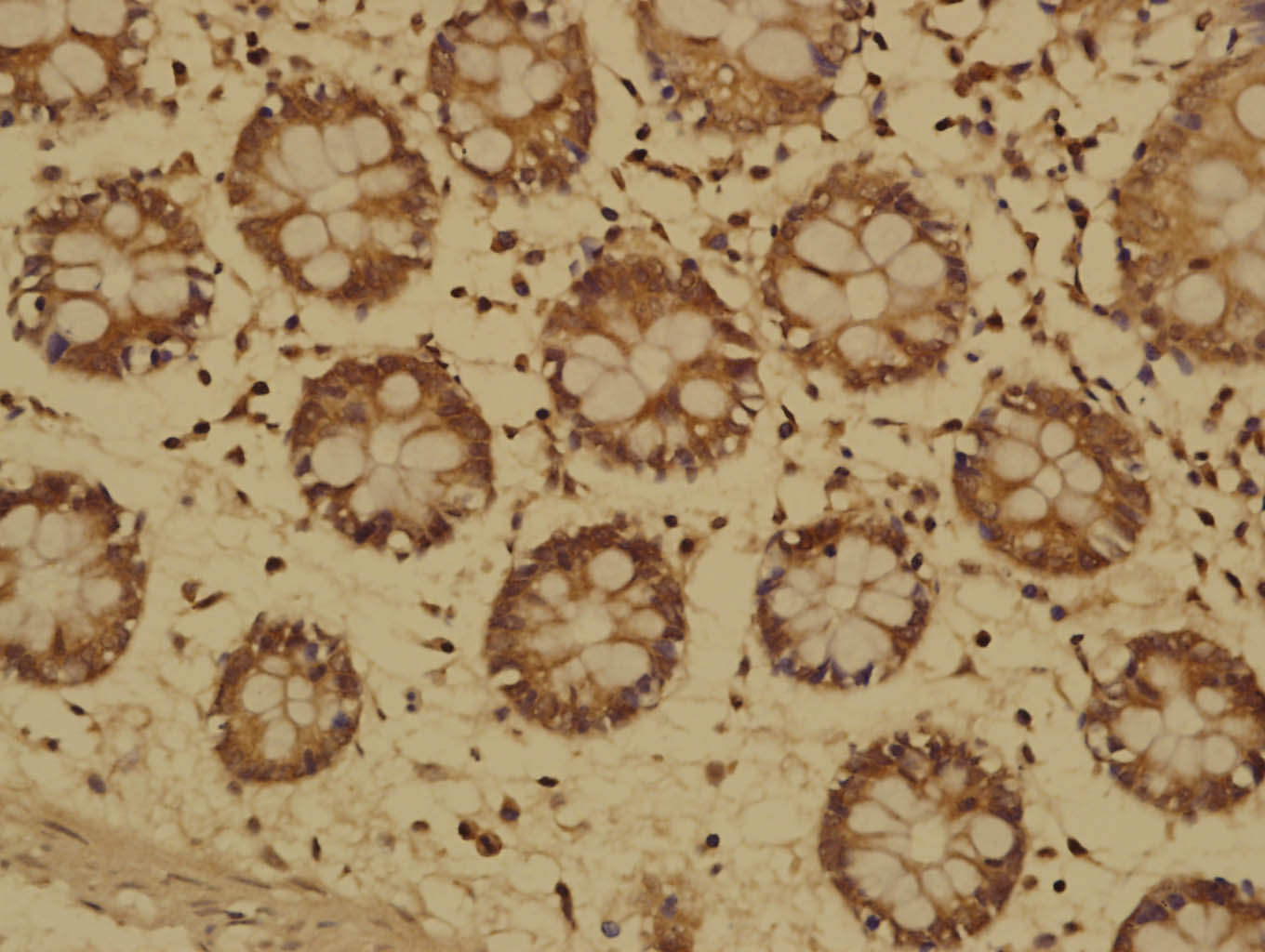 Paraformaldehyde-fixed, paraffin embedded Human cervical carcinoma; Antigen retrieval by boiling in sodium citrate buffer (pH6.0) for 15min; Block endogenous peroxidase by 3% hydrogen peroxide for 20 minutes; Blocking buffer (normal goat serum) at 37°C for 30min; Antibody incubation with MTM1 Polyclonal Antibody, Unconjugated (bs-9178R ) at 1:500 overnight at 4°C, followed by a conjugated secondary for 20 minutes and DAB staining.