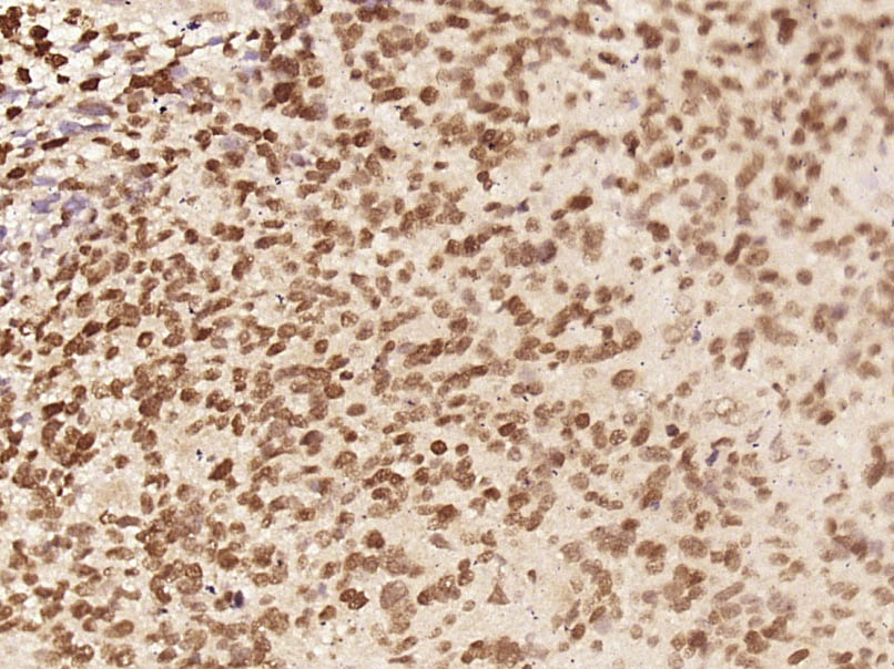 Paraformaldehyde-fixed, paraffin embedded Human neuroglioma; Antigen retrieval by boiling in sodium citrate buffer (pH6) for 15min; Block endogenous peroxidase by 3% hydrogen peroxide for 30 minutes; Blocking buffer (normal goat serum) at 37°C for 20min; Antibody incubation with C8orf58 Polyclonal Antibody, Unconjugated (bs-15297R) at 1:400 overnight at 4°C, followed by a conjugated secondary and DAB staining.