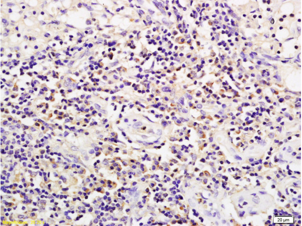 Formalin-fixed and paraffin embedded rat transplant lymphoma labeled with Anti-CD19 Polyclonal Antibody (bs-0079R), Unconjugated 1:200 followed by conjugation to the secondary antibody and DAB staining