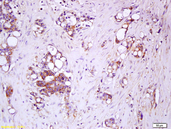 Formalin-fixed and paraffin embedded human colon carcinoma labeled with Rabbit Anti-IL-17RC/IL-17RL Polyclonal Antibody, Unconjugated (bs-2607R) at 1:200 followed by conjugation to the secondary antibody and DAB staining.