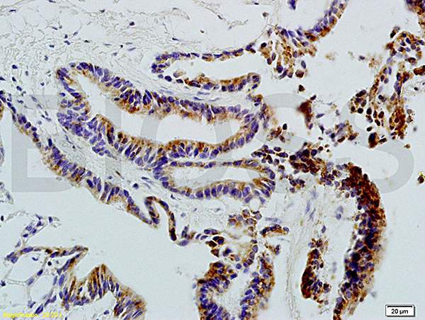 Formalin-fixed and paraffin embedded human colon carcinoma labeled with Anti-CD20 Polyclonal Antibody (bs-0080R), Unconjugated 1:200 followed by conjugation to the secondary antibody and DAB staining