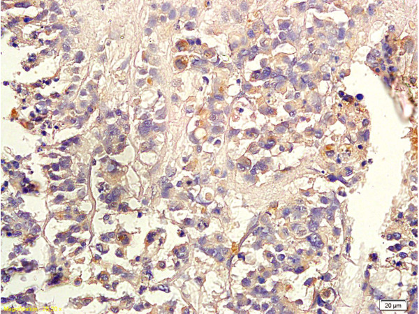 Formalin-fixed and paraffin embedded human colon carcinoma labeled with Anti-TGF-beta-2 Polyclonal Antibody, Unconjugated(bs-0100R) 1:300 followed by conjugation to the secondary antibody and DAB staining