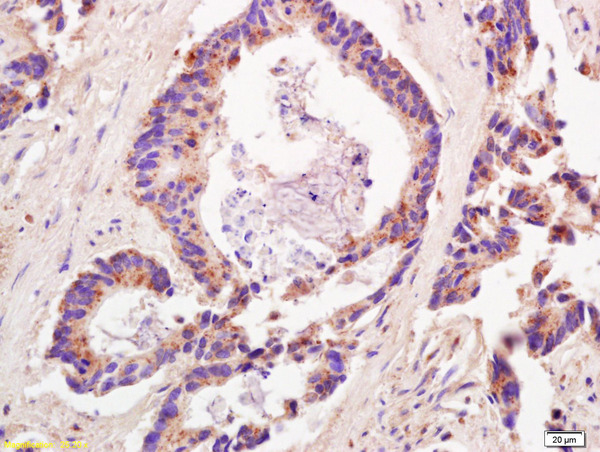 Formalin-fixed and paraffin embedded human colon carcinoma labeled with Anti-ADAMTS12 Polyclonal Antibody, Unconjugated (bs-1385R) at 1:200 followed by conjugation to the secondary antibody and DAB staining.