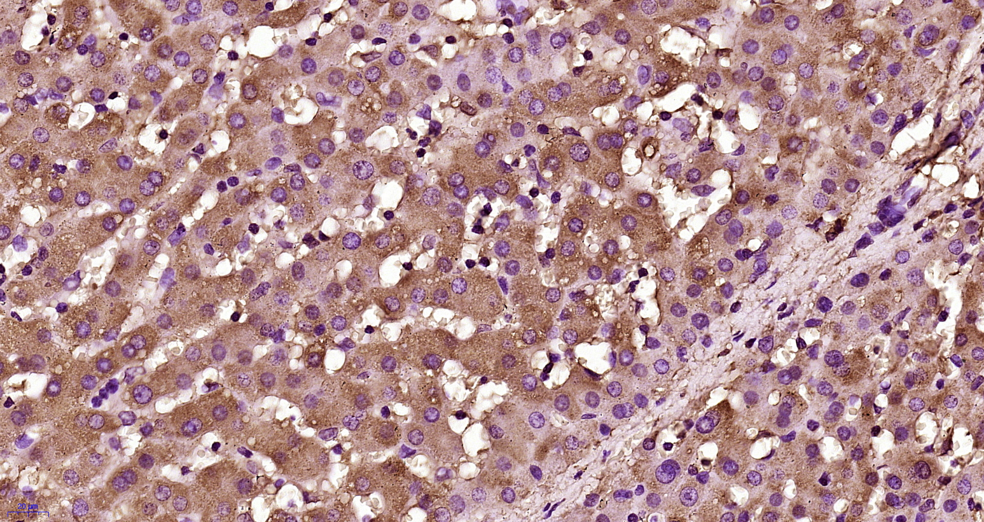 Paraformaldehyde-fixed, paraffin embedded human liver; Antigen retrieval by boiling in sodium citrate buffer (pH6.0) for 15min; Block endogenous peroxidase by 3% hydrogen peroxide for 20 minutes; Blocking buffer (normal goat serum) at 37°C for 30min; Antibody incubation with Plasminogen Polyclonal Antibody, Unconjugated (bs-1828R) at 1:400 overnight at 4°C, followed by operating according to SP Kit(Rabbit) instructions and DAB staining.