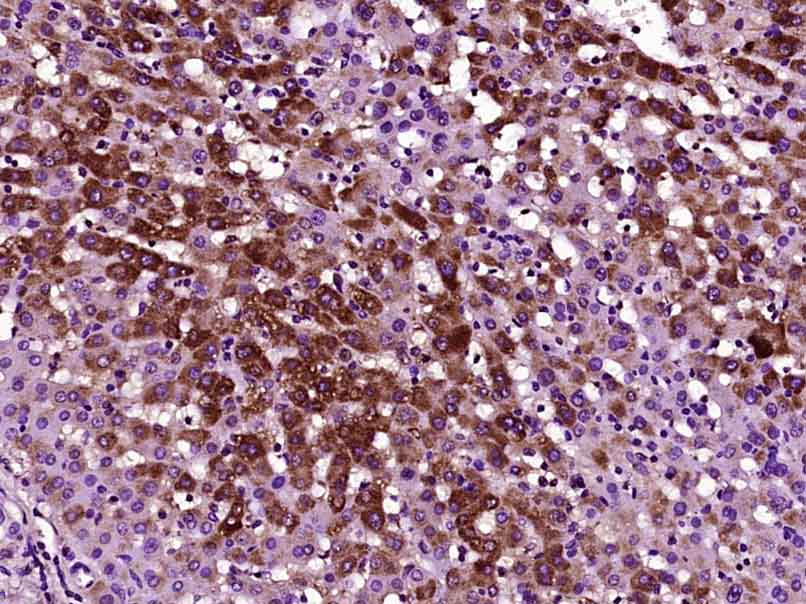 Paraformaldehyde-fixed, paraffin embedded; Antigen retrieval by boiling in sodium citrate buffer (pH6) for 15min; Block endogenous peroxidase by 3% hydrogen peroxide for 30 minutes; Blocking buffer (normal goat serum) at 37°C for 20min; Antibody incubation with MASP2 Polyclonal Antibody, Unconjugated (bs-1980R)at 1:200 overnight at 4°C, followed by a conjugated secondary and DAB staining.