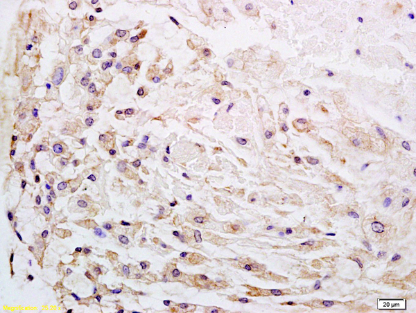 Formalin-fixed and paraffin embedded human gastric carcinoma labeled with Anti-Wnt1 Polyclonal Antibody, Unconjugated (bs-1739R) at 1:200 followed by conjugation to the secondary antibody and DAB staining.