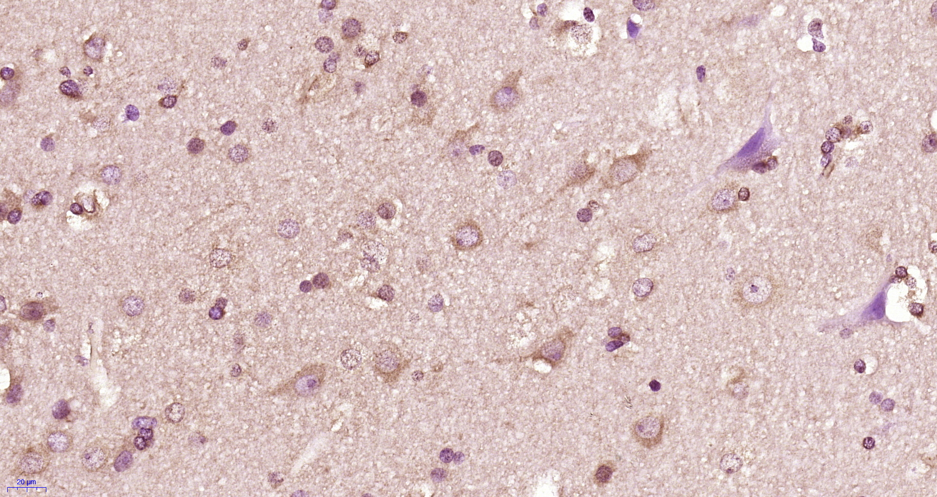 Paraformaldehyde-fixed, paraffin embedded human glioma; Antigen retrieval by boiling in sodium citrate buffer (pH6) for 15min; Block endogenous peroxidase by 3% hydrogen peroxide for 30 minutes; Blocking buffer (normal goat serum) at 37\u00b0C for 20min; Antibody incubation with 14-3-3 beta Polyclonal Antibody, Unconjugated (bs-12420R) at 1:400 overnight at 4\u00b0C, followed by a conjugated secondary and DAB staining.