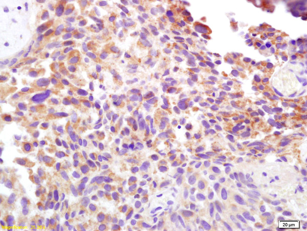 Formalin-fixed and paraffin embedded human bladder carcinoma labeled with Rabbit Anti CD138\/Syndecan-1 Polyclonal Antibody, Unconjugated (bs-1309R) at 1:200 followed by conjugation to the secondary antibody and DAB staining