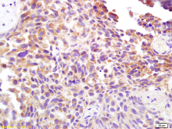 Formalin-fixed and paraffin embedded human bladder carcinoma labeled with Rabbit Anti CD138/Syndecan-1 Polyclonal Antibody, Unconjugated (bs-1309R) at 1:200 followed by conjugation to the secondary antibody and DAB staining Formalin-fixed and paraffin embedded human bladder carcinoma labeled with Rabbit Anti CD138/Syndecan-1 Polyclonal Antibody, Unconjugated (bs-1309R) at 1:200 followed by conjugation to the secondary antibody and DAB staining