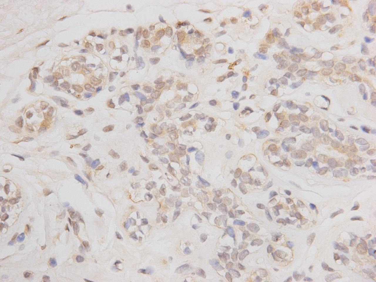 Paraformaldehyde-fixed, paraffin embedded human breast cancer; Antigen retrieval by boiling in sodium citrate buffer (pH6) for 15min; Block endogenous peroxidase by 3% hydrogen peroxide for 30 minutes; Blocking buffer (normal serum) at 37°C for 20min; Antibody incubation with BCL-2 (2C4) Monoclonal Antibody (bsm-52022M) at 1:50 overnight at 4°C, followed by a conjugated secondary and DAB staining.
