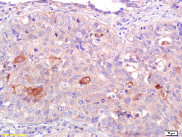 Formalin-fixed and paraffin embedded human lung carcinoma labeled with Anti-CNR2/CB2 Polyclonal Antibody, Unconjugated (bs-2377R) at 1:200 followed by conjugation to the secondary antibody and DAB staining.