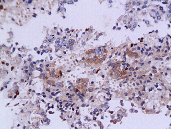 Formalin-fixed and paraffin embedded human pituitary tumor labeled with Anti-TGF-beta1 Polyclonal Antibody (bs-0103R), Unconjugated 1:200 followed by conjugation to the secondary antibody and DAB staining