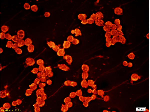 Oral squamous cell carcinoma labeled with Anti-TGF-beta1 Polyclonal Antibody (bs-0103R), Unconjugated 1:200 followed by conjugation to the secondary antibody Goat Anti-Rabbit IgG, PE-Cy3 conjugated(bs-0295G-PE-Cy3)used at 1:200 dilution for 40 minutes at 37°C