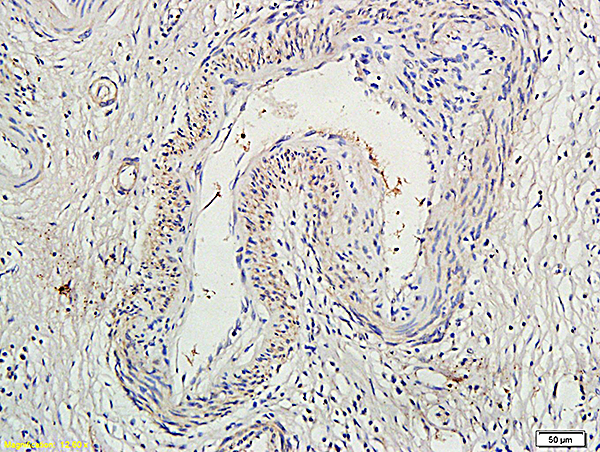 Formalin-fixed and paraffin embedded human colon cancer labeled with Anti-Socs1Polyclonal Antibody (bs-0113R), Unconjugated at 1:300, followed by conjugation to the secondary antibody and DAB staining