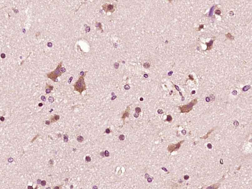 Paraformaldehyde-fixed, paraffin embedded human brain glioma; Antigen retrieval by boiling in sodium citrate buffer (pH6) for 15min; Block endogenous peroxidase by 3% hydrogen peroxide for 30 minutes; Blocking buffer (normal goat serum) at 37°C for 20min; Antibody incubation with ASK1 (Ser966) Polyclonal Antibody (bs-3007R)at 1:400 overnight at 4°C, followed by a conjugated secondary and DAB staining.