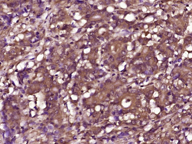 Paraformaldehyde-fixed, paraffin embedded human colon cancer; Antigen retrieval by boiling in sodium citrate buffer (pH6) for 15min; Block endogenous peroxidase by 3% hydrogen peroxide for 30 minutes; Blocking buffer (normal goat serum) at 37°C for 20min; Antibody incubation with RPS6KB1(Thr 412) Polyclonal Antibody (bs-5669R) at 1:400 overnight at 4°C, followed by a conjugated secondary and DAB staining.