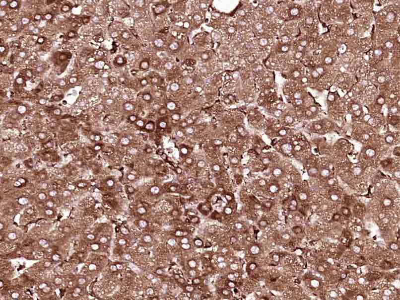 Paraformaldehyde-fixed, paraffin embedded human liver carcinoma; Antigen retrieval by boiling in sodium citrate buffer (pH6.0) for 15min; Block endogenous peroxidase by 3% hydrogen peroxide for 20 minutes; Blocking buffer (normal goat serum) at 37°C for 30min; Antibody incubation with MEK2 Monoclonal Antibody (bsm-33216M) at 1:400 overnight at 4°C, followed by SP Kit(Mouse) according to instructions and DAB staining.