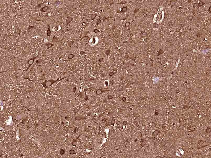 Paraformaldehyde-fixed, paraffin embedded human brain glioma; Antigen retrieval by boiling in sodium citrate buffer (pH6.0) for 15min; Block endogenous peroxidase by 3% hydrogen peroxide for 20 minutes; Blocking buffer (normal goat serum) at 37°C for 30min; Antibody incubation with MEK2 Monoclonal Antibody (bsm-33216M) at 1:400 overnight at 4°C, followed by SP Kit(Mouse) according to instructions and DAB staining.