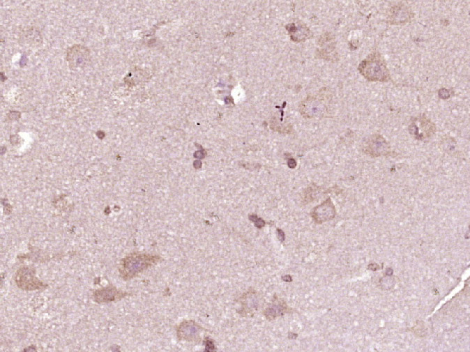 Paraformaldehyde-fixed, paraffin embedded human glioma; Antigen retrieval by boiling in sodium citrate buffer (pH6) for 15min; Block endogenous peroxidase by 3% hydrogen peroxide for 30 minutes; Blocking buffer (normal goat serum) at 37°C for 20min; Antibody incubation with ATP7A Polyclonal Antibody (bs-1572R) at 1:400 overnight at 4°C, followed by a conjugated secondary and DAB staining.