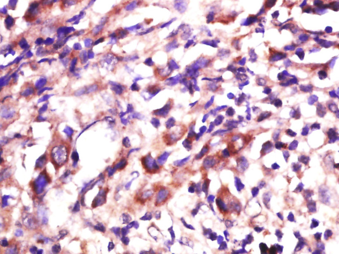 Paraformaldehyde-fixed, paraffin embedded human cervical cancer; Antigen retrieval by boiling in sodium citrate buffer (pH6) for 15min; Block endogenous peroxidase by 3% hydrogen peroxide for 30 minutes; Blocking buffer (normal goat serum) at 37°C for 20min; Antibody incubation with_x000D_ PBOV1 Polyclonal Antibody (bs-5939R) at 1:400 overnight at 4°C, followed by a conjugated secondary and DAB staining.