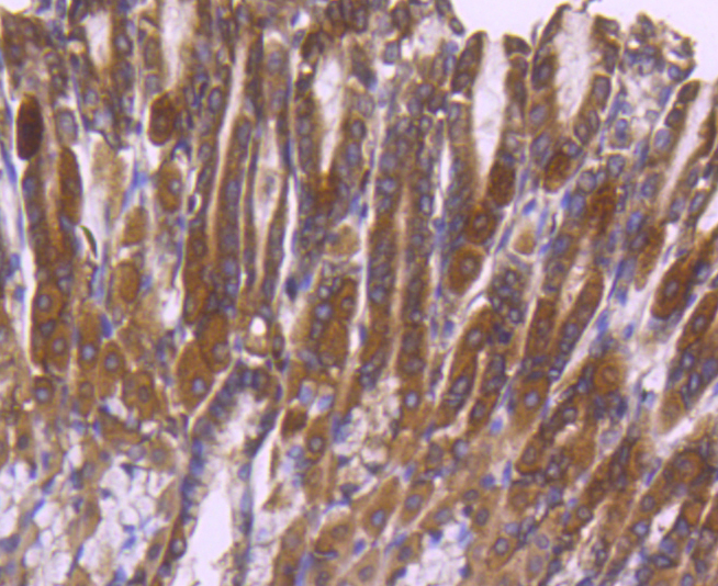 Paraformaldehyde-fixed, paraffin embedded Human breast carcinoma; Antigen retrieval by boiling in sodium citrate buffer (pH6) for 15min; Block endogenous peroxidase by 3% hydrogen peroxide for 30 minutes; Blocking buffer at 37°C for 20min; Antibody incubation with ERK2 (3G1) Monoclonal Antibody (bsm-52068R) at 1:50 overnight at 4°C, followed by a conjugated secondary and DAB staining.