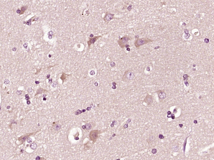 Paraformaldehyde-fixed, paraffin embedded human brain glioma; Antigen retrieval by boiling in sodium citrate buffer (pH6) for 15min; Block endogenous peroxidase by 3% hydrogen peroxide for 30 minutes; Blocking buffer (normal goat serum) at 37°C for 20min; Antibody incubation with CTRP2 Polyclonal Antibody (bs-12934R) at 1:400 overnight at 4°C, followed by a SP kit and DAB staining.