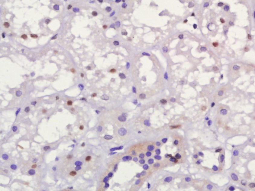 Paraformaldehyde-fixed, paraffin embedded human kidney; Antigen retrieval by boiling in sodium citrate buffer (pH6) for 15min; Block endogenous peroxidase by 3% hydrogen peroxide for 30 minutes; Blocking buffer (normal goat serum) at 37°C for 20min; Antibody incubation with MUM1 Polyclonal Antibody (bs-6811R) at 1:400 overnight at 4°C, followed by a conjugated secondary and DAB staining.