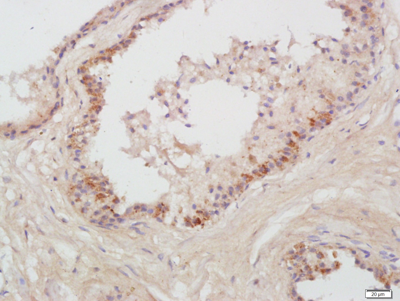 Paraformaldehyde-fixed, paraffin embedded human prostate; Antigen retrieval by boiling in sodium citrate buffer (pH6) for 15min; Block endogenous peroxidase by 3% hydrogen peroxide for 30 minutes; Blocking buffer (normal goat serum) at 37°C for 20min; Antibody incubation with Prostatic Acid Phosphatase Antibody (bs-6293R) at 1:200 overnight at 4°C, followed by a conjugated secondary and DAB staining.