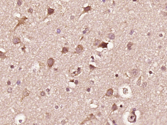 Paraformaldehyde-fixed, paraffin embedded human glioma; Antigen retrieval by boiling in sodium citrate buffer (pH6) for 15min; Block endogenous peroxidase by 3% hydrogen peroxide for 30 minutes; Blocking buffer (normal goat serum) at 37°C for 20min; Antibody incubation with INPPL1(Tyr1135) Polyclonal Antibody (bs-3399R) at 1:400 overnight at 4°C, followed by a conjugated secondary and DAB staining.