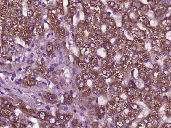 Paraformaldehyde-fixed, paraffin embedded human liver cancer; Antigen retrieval by boiling in sodium citrate buffer (pH6) for 15min; Block endogenous peroxidase by 3% hydrogen peroxide for 30 minutes; Blocking buffer (normal goat serum) at 37°C for 20min; Antibody incubation with SCD1 Polyclonal Antibody (bs-3787R) at 1:400 overnight at 4°C, followed by a conjugated secondary and DAB staining.