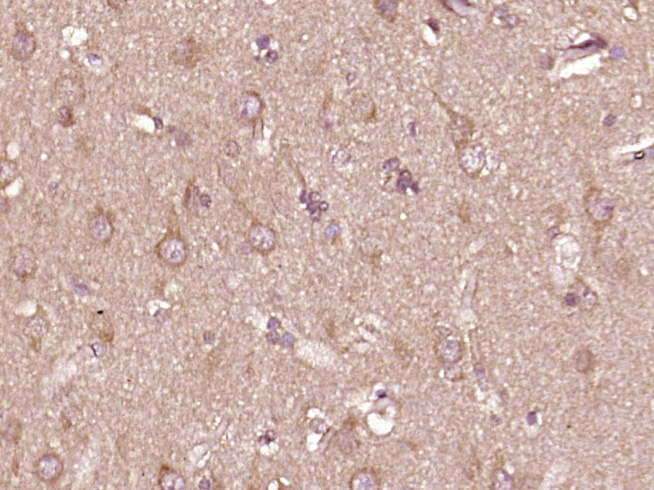 Paraformaldehyde-fixed, paraffin embedded human glioma; Antigen retrieval by boiling in sodium citrate buffer (pH6) for 15min; Block endogenous peroxidase by 3% hydrogen peroxide for 30 minutes; Blocking buffer (normal goat serum) at 37°C for 20min; Antibody incubation with PTPN6(Tyr536) Polyclonal Antibody (bs-5577R) at 1:400 overnight at 4°C, followed by a conjugated secondary and DAB staining.