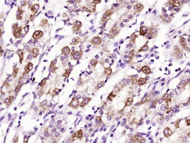 Paraformaldehyde-fixed, paraffin embedded human stomach tissue; Antigen retrieval by boiling in sodium citrate buffer (pH6.0) for 15min; Block endogenous peroxidase by 3% hydrogen peroxide for 20 minutes; Blocking buffer (normal goat serum) at 37°C for 30min; Antibody incubation with (Glucagon Receptor) Polyclonal Antibody, Unconjugated (bs-3945R) at 1:400 overnight at 4°C, followed by a conjugated secondary antibody and DAB staining.