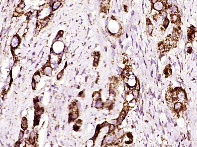 Paraformaldehyde-fixed, paraffin embedded human gastric cancer; Antigen retrieval by boiling in sodium citrate buffer (pH6) for 15min; Block endogenous peroxidase by 3% hydrogen peroxide for 30 minutes; Blocking buffer (normal goat serum) at 37°C for 20min; Antibody incubation with ADAM17 (Thr735) Polyclonal Antibody (bs-12477R) at 1:400 overnight at 4°C, followed by a conjugated secondary and DAB staining.