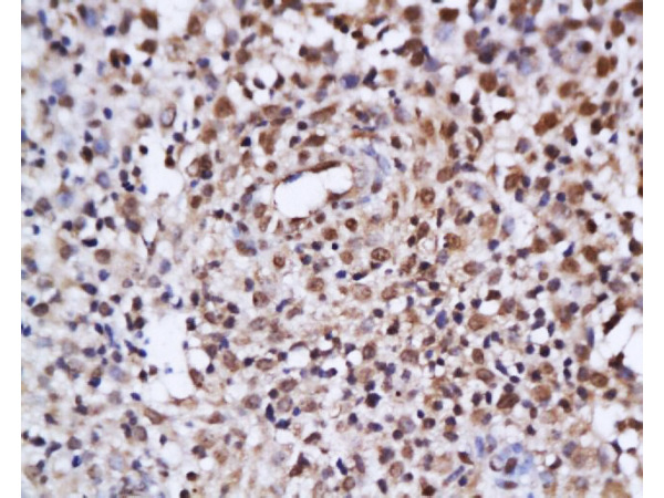 Formalin-fixed and paraffin embedded human endometrium tissue labeled with Anti-ER-alpha\/beta Polyclonal Antibody, Unconjugated (bs-0174R) at 1:200 followed by conjugation to the secondary antibody and DAB staining