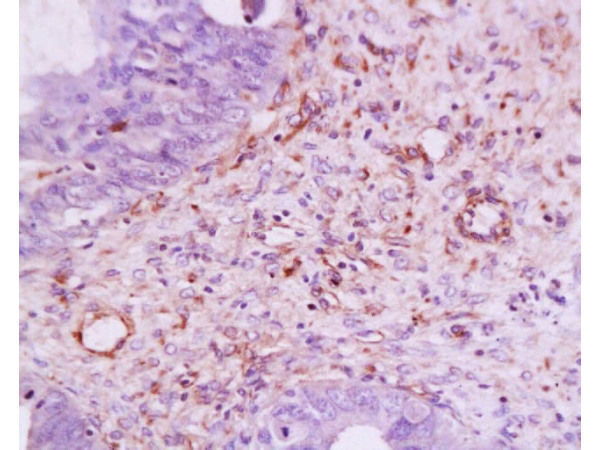 Formalin-fixed and paraffin embedded: human ovary carcinoma labeled with Anti-VEGF Polyclonal Antibody, Unconjugated(bs-0279R)  at 1:200, followed by conjugation to the secondary antibody and DAB staining