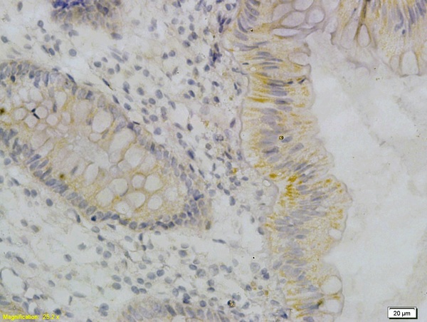 Formalin-fixed and paraffin embedded:human colon labeled with Anti-TNF-Alpha Polyclonal Antibody, Unconjugated (bsm-0387M), followed by conjugation to the secondary antibody and DAB staining