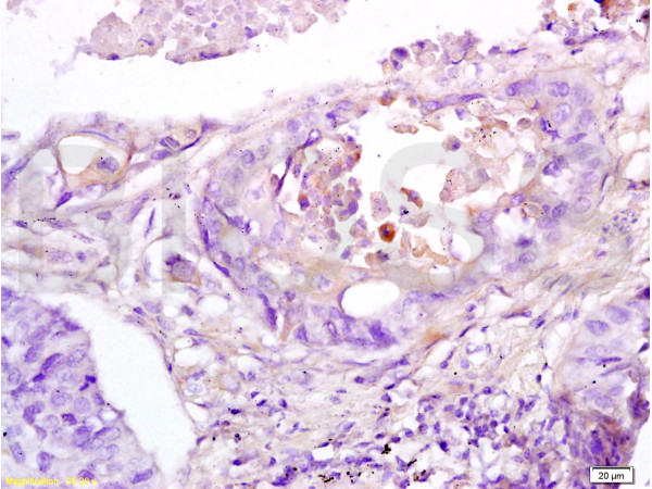 Formalin-fixed and paraffin embedded human lung cancer tissue labeled with Anti-RAP1A Polyclonal Antibody, Unconjugated (bs-1504R) at 1:200 followed by conjugation to the secondary antibody, (SP-0023), and DAB staining