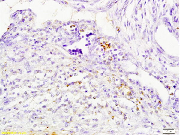 Formalin-fixed and paraffin embedded human breast carcinoma tissue labeled with Anti-Cathepsin H Polyclonal Antibody, Unconjugated (bs-1670R) at 1:200 followed by conjugation to the secondary antibody, (SP-0023), and DAB staining