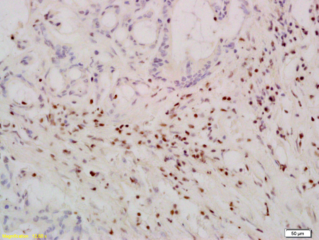 Paraformaldehyde-fixed, paraffin embedded Human Colon cancer; Antigen retrieval by boiling in sodium citrate buffer (pH6.0) for 15min; Block endogenous peroxidase by 3% hydrogen peroxide for 20 minutes; Blocking buffer (normal goat serum) at 37°C for 30min; Antibody incubation with TERT Polyclonal Antibody, Unconjugated (bs-0233R) at 1:200 overnight at 4°C, DAB staining.