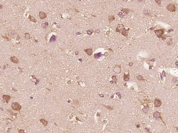 Paraformaldehyde-fixed, paraffin embedded Human brain glioma; Antigen retrieval by boiling in sodium citrate buffer (pH6.0) for 15min; Block endogenous peroxidase by 3% hydrogen peroxide for 20 minutes; Blocking buffer (normal goat serum) at 37°C for 30min; Antibody incubation with IL-13 Polyclonal Antibody, Unconjugated (bs-0560R) at 1:400 overnight at 4°C, DAB staining. Paraformaldehyde-fixed, paraffin embedded Human brain glioma; Antigen retrieval by boiling in sodium citrate buffer (pH6.0) for 15min; Block endogenous peroxidase by 3% hydrogen peroxide for 20 minutes; Blocking buffer (normal goat serum) at 37°C for 30min; Antibody incubation with IL-13 Polyclonal Antibody, Unconjugated (bs-0560R) at 1:400 overnight at 4°C, DAB staining.