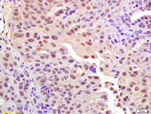 Formalin-fixed and paraffin embedded human bladder carcinoma labeled with Anti-Phospho-Histone H2A.X (Ser139) Polyclonal Antibody, Unconjugated (bs-3185R) at 1:200 followed by conjugation to the secondary antibody and DAB staining.
