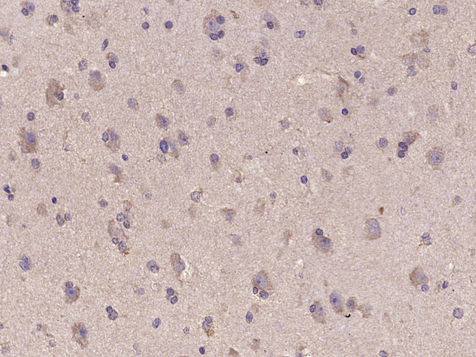 Paraformaldehyde-fixed, paraffin embedded Human brain glioma; Antigen retrieval by boiling in sodium citrate buffer (pH6.0) for 15min; Block endogenous peroxidase by 3% hydrogen peroxide for 20 minutes; Blocking buffer (normal goat serum) at 37°C for 30min; Antibody incubation with IDH1 Polyclonal Antibody, Unconjugated (bs-9634R) at 1:400 overnight at 4°C, DAB staining. Paraformaldehyde-fixed, paraffin embedded Human brain glioma; Antigen retrieval by boiling in sodium citrate buffer (pH6.0) for 15min; Block endogenous peroxidase by 3% hydrogen peroxide for 20 minutes; Blocking buffer (normal goat serum) at 37°C for 30min; Antibody incubation with IDH1 Polyclonal Antibody, Unconjugated (bs-9634R) at 1:400 overnight at 4°C, DAB staining.