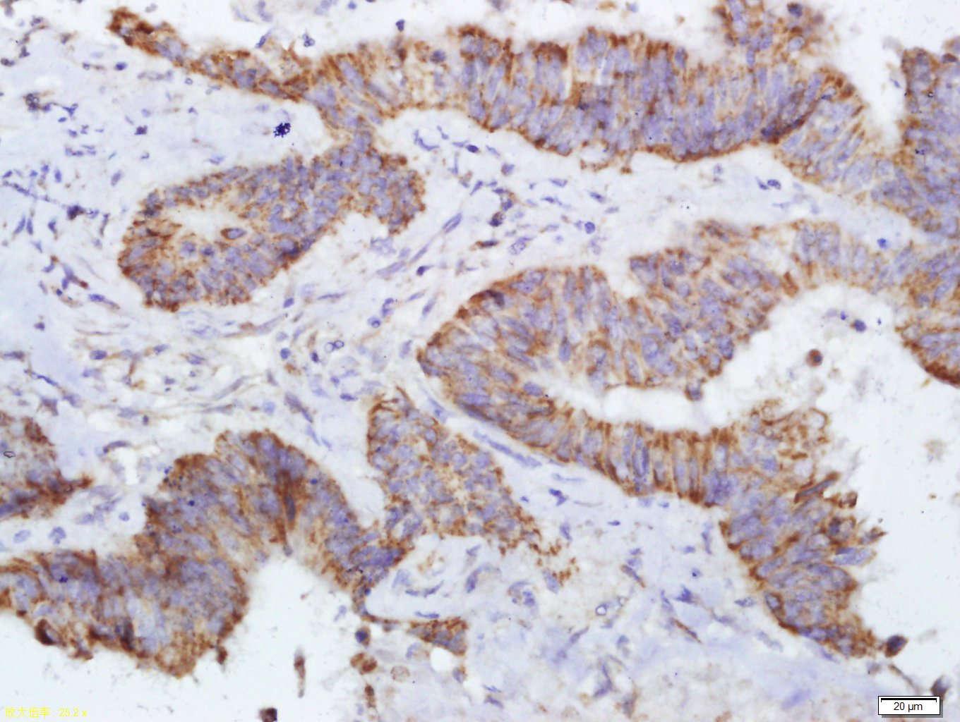Paraformaldehyde-fixed, paraffin embedded Human colon cancer; Antigen retrieval by boiling in sodium citrate buffer (pH6.0) for 15min; Block endogenous peroxidase by 3% hydrogen peroxide for 20 minutes; Blocking buffer (normal goat serum) at 37°C for 30min; Antibody incubation with DERLIN-1 Polyclonal Antibody, Unconjugated (bs-11268R) at 1:600 overnight at 4°C, DAB staining.