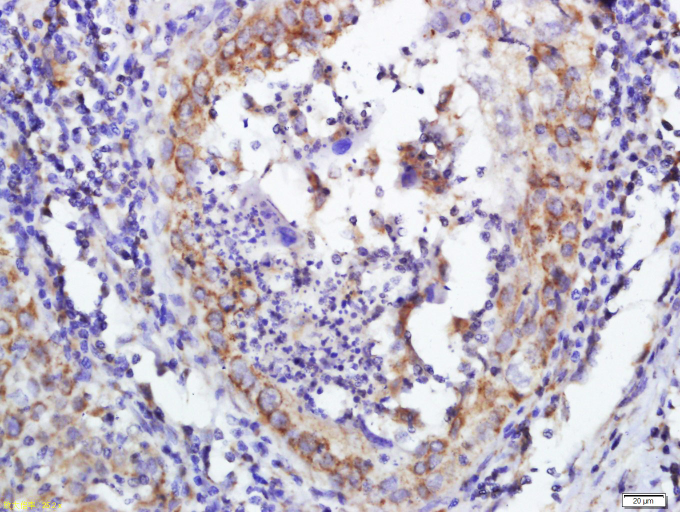 Paraformaldehyde-fixed, paraffin embedded Human esophagus cancer; Antigen retrieval by boiling in sodium citrate buffer (pH6.0) for 15min; Block endogenous peroxidase by 3% hydrogen peroxide for 20 minutes; Blocking buffer (normal goat serum) at 37°C for 30min; Antibody incubation with DERLIN-1 Polyclonal Antibody, Unconjugated (bs-11268R) at 1:600 overnight at 4°C, DAB staining.