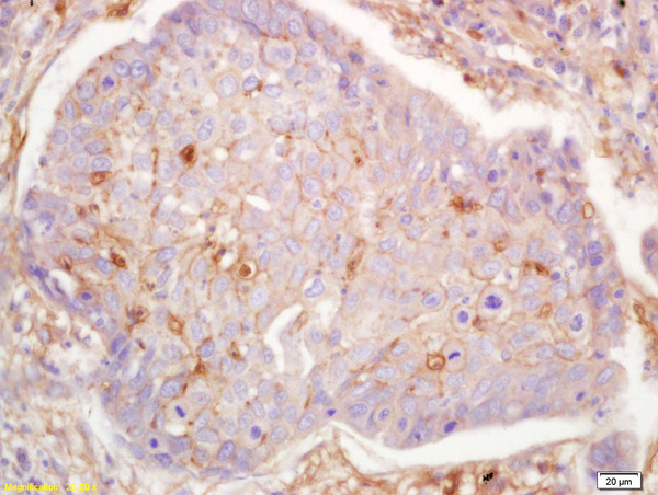 Formalin-fixed and paraffin embedded human lung carcinoma labeled with Anti-G protein alpha S Polyclonal Antibody, Unconjugated (bs-3939R) at 1:200 followed by conjugation to the secondary antibody and DAB staining.
