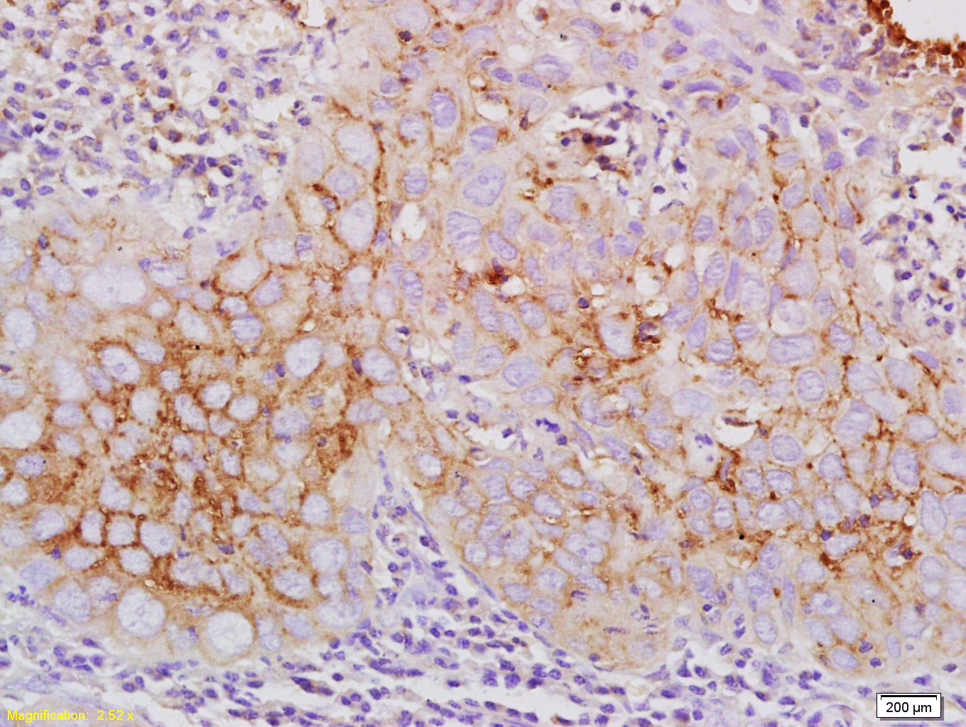 Paraformaldehyde-fixed, paraffin embedded human laryngeal cancer; Antigen retrieval by boiling in sodium citrate buffer (pH6.0) for 15min; Block endogenous peroxidase by 3% hydrogen peroxide for 20 minutes; Blocking buffer (normal goat serum) at 37°C for 30min; Antibody incubation with Claudin 10 Polyclonal Antibody, Unconjugated (bs-13739R) at 1:200 overnight at 4°C, DAB staining.