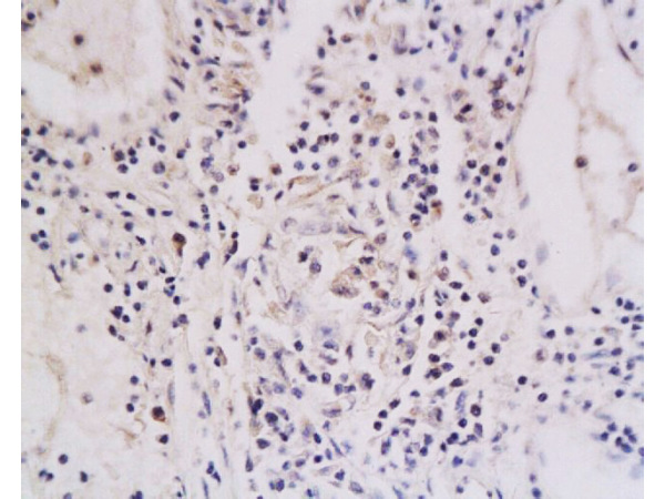 Formalin-fixed and paraffin embedded human oral squamous cell carcinoma labeled with Anti-TNFRSF18 Polyclonal Antibody (bs-1173R), Unconjugated at 1:200, followed by conjugation to the secondary antibody and DAB staining