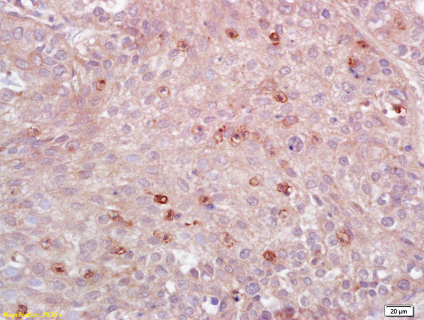 Formalin-fixed and paraffin embedded human lung carcinoma labeled with Anti-MHC Class II/HLA-DPB1 Polyclonal Antibody, Unconjugated (bs-4107R) at 1:200 followed by conjugation to the secondary antibody and DAB staining.