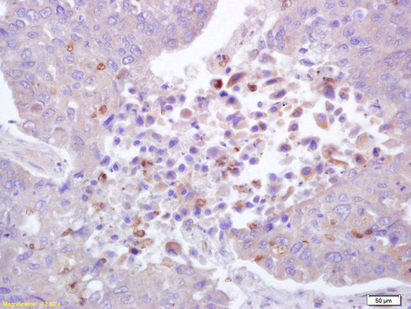Formalin-fixed and paraffin embedded human lung carcinoma labeled with Anti-phospho-ROCK1(Thr455\/Ser456) Polyclonal Antibody, Unconjugated (bs-4630R) at 1:200 followed by conjugation to the secondary antibody and DAB staining.