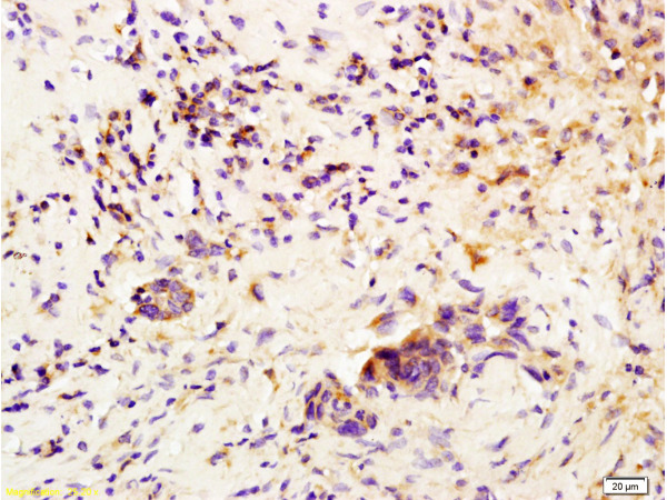 Formalin-fixed and paraffin embedded human rectal carcinoma labeled with Anti-CSF3/G-CSF Polyclonal Antibody (bs-1023R), Unconjugated at 1:200, followed by conjugation to the secondary antibody and DAB staining.